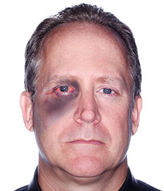 תמונת גבר עם חבלה בעין (פנס). עינו אדומה ומסביבה שטף דם סגול המכסה את ארובת העין וחלקית את לחיו