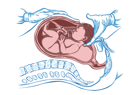 במהלך ניתוח קיסרי חודרים על ידי חתך דרך כל השכבות, על מנת להגיע אל הרחם ולהוציא את התינוק